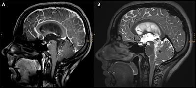 Case report: Impact of mixed reality on anatomical understanding and surgical planning in a complex fourth ventricular tumor extending to the lamina quadrigemina